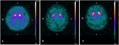 High Prevalence of Early Parkinson's Disease in Patients With Subtle Parkinsonian Signs